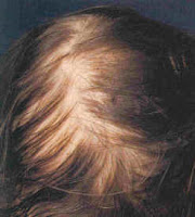hairloss.jpg